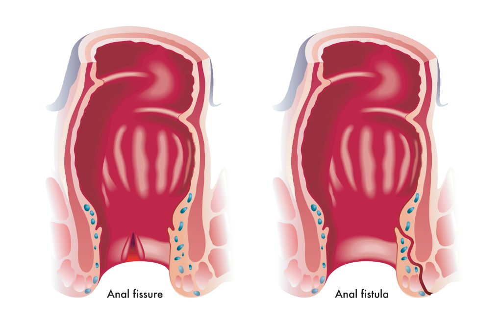 Anal Fissure Treatment